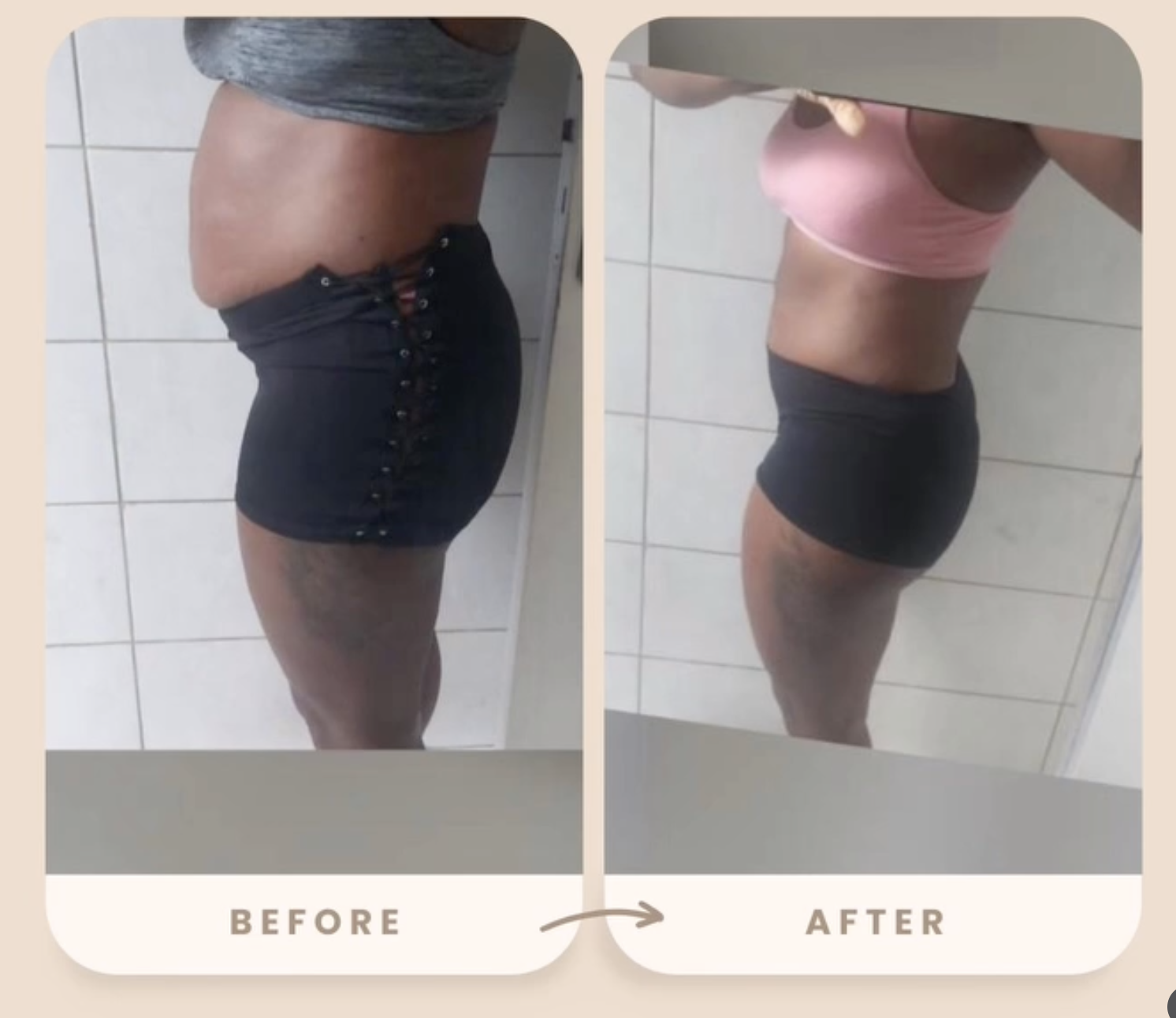 Avant / après ventre & taille — Fatou, 3 séances de cryolipolyse